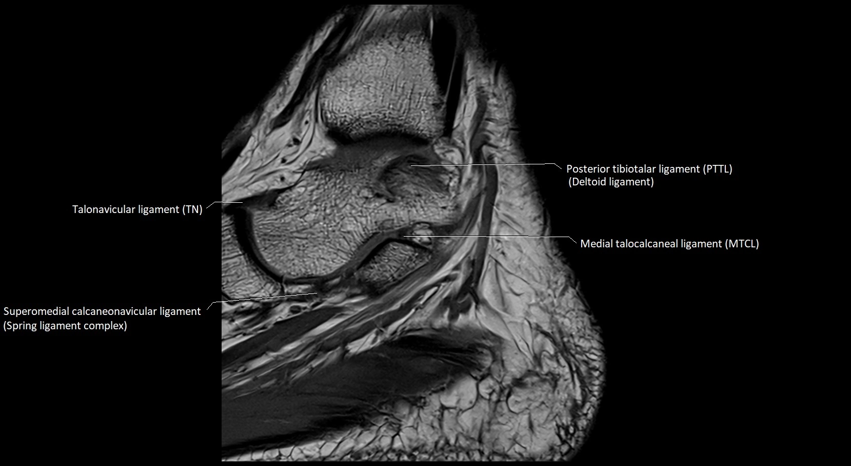 MRI ankle ligaments anatomy sagittal 3T image 7.webp